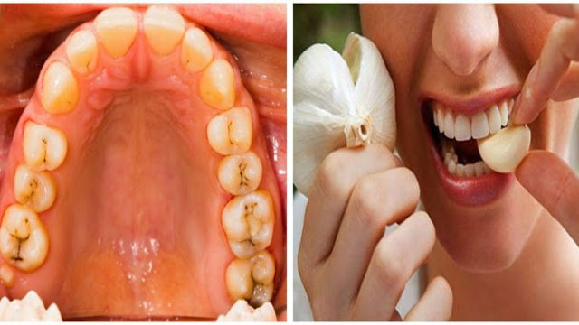treatment for tooth decay in adults