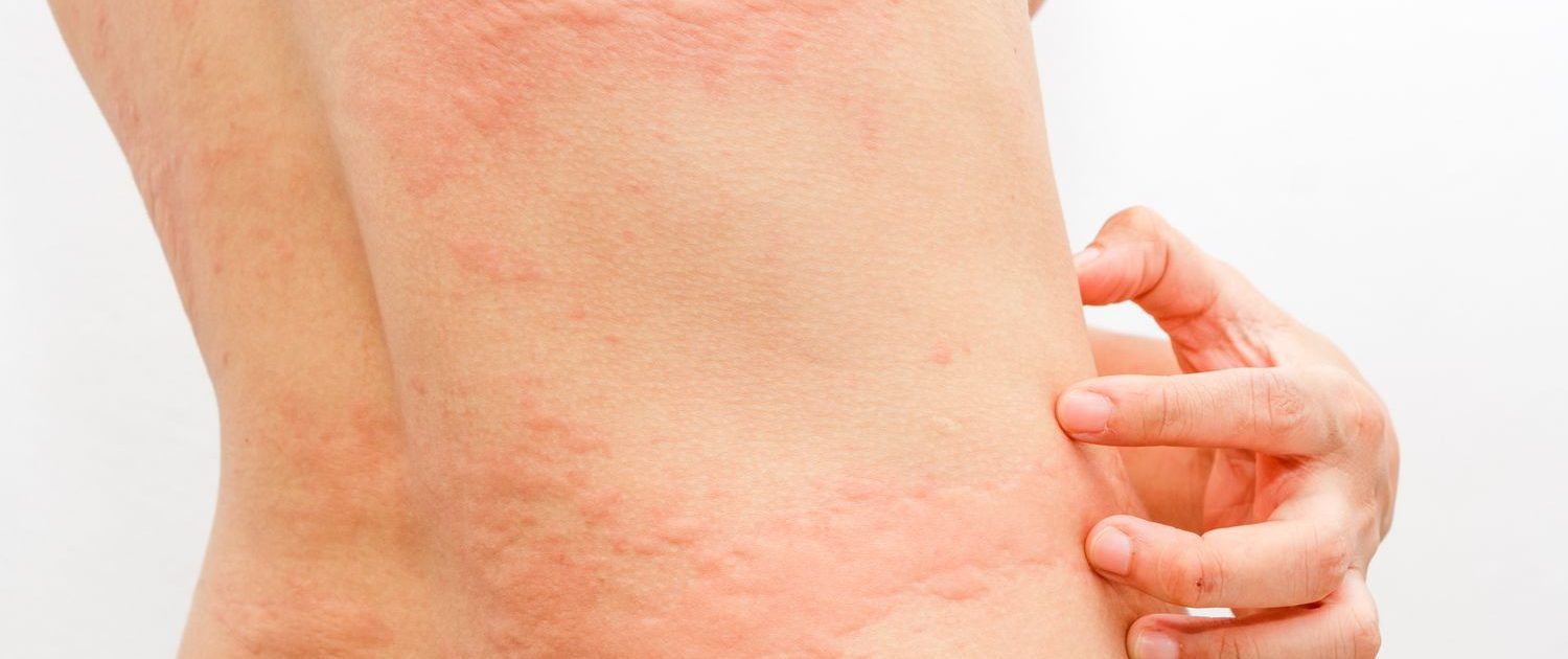 Cold Urticaria Symptoms Causes And How To Treat Being Allergic To